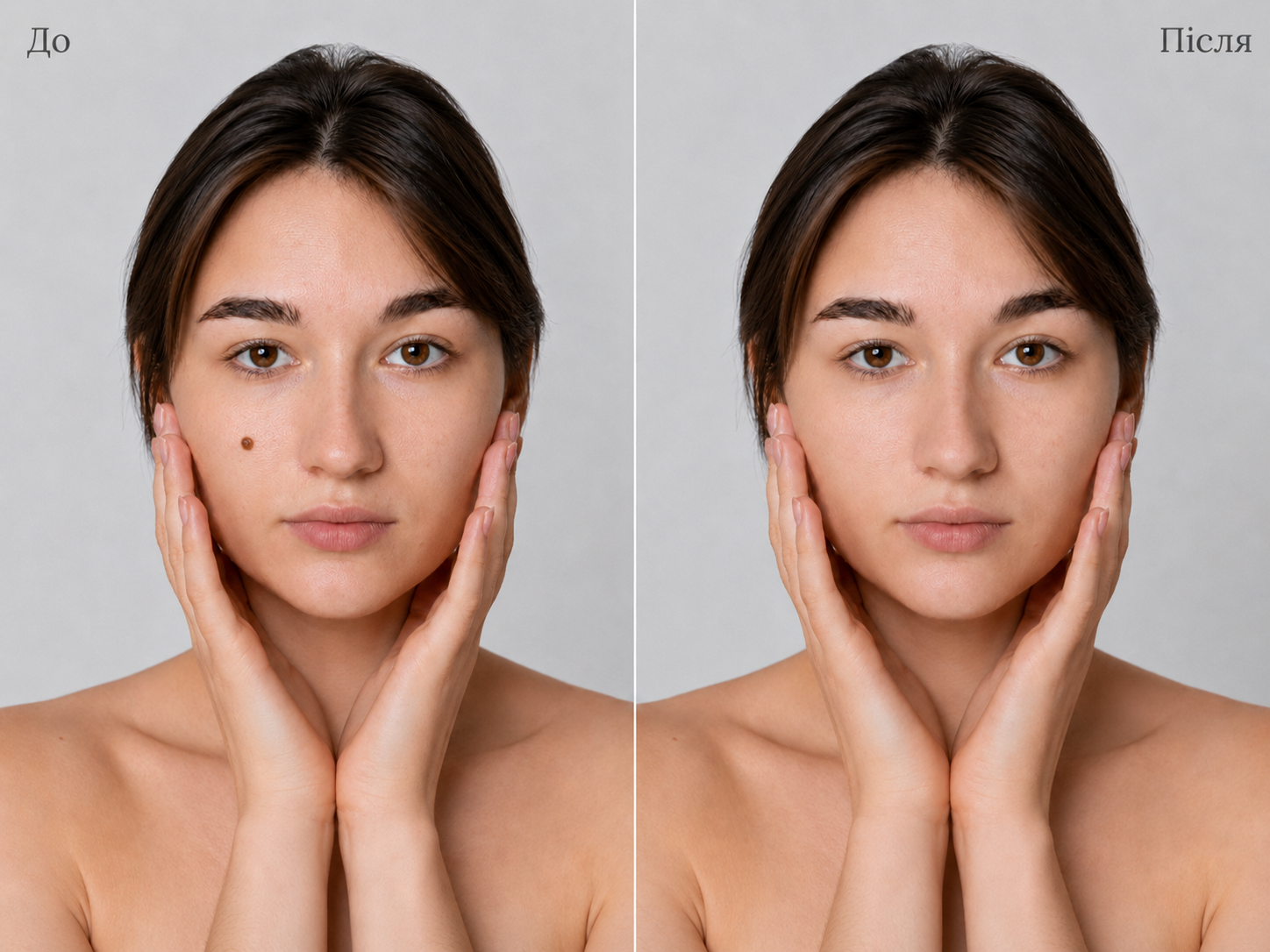 Родимка на обличчі до та після видалення у SkinCare Clinic в Києві