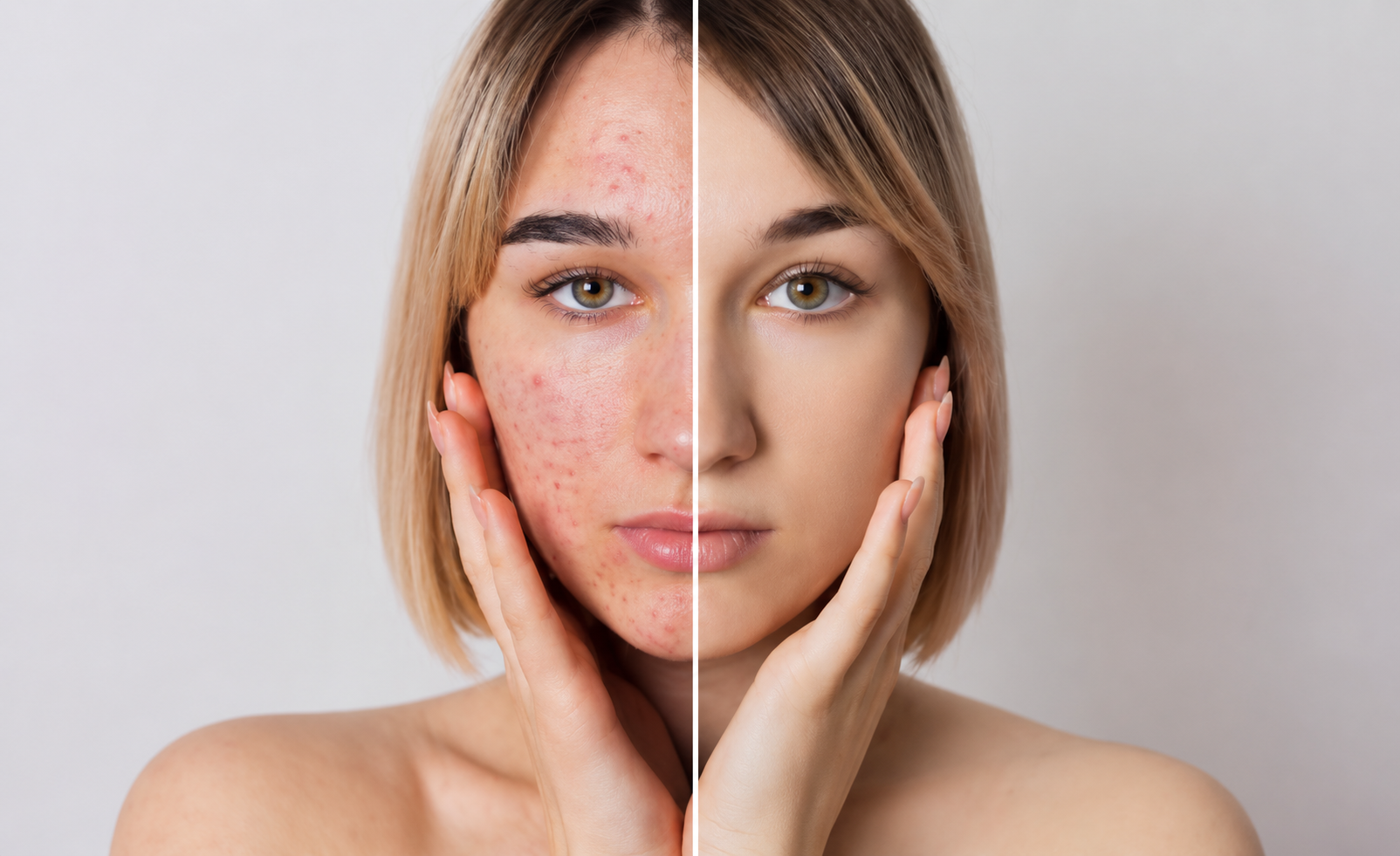 Акне до та після лікування у SkinCare Clinic в Києві